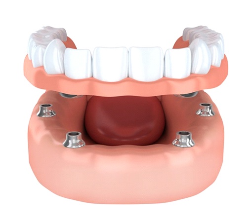 A diagram of an All-on-4 dental implant restoration.