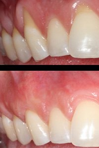 Closeup of smile before and after gum grafting