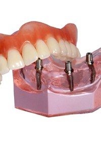 A model of an All-on-4 dental implant restoration.