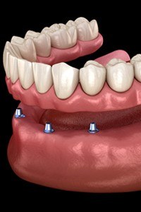 implant-retained denture