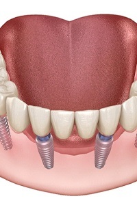 full mouth replacement