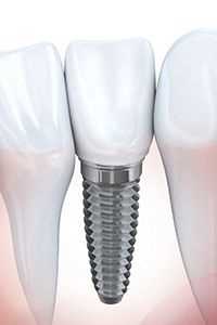 Animation of implant supported dental crown