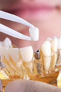 Model smile with implant supported replacement tooth