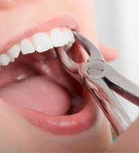 A patient’s tooth undergoing tooth extraction