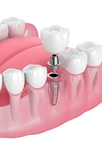 Illustration of single dental implant and its restoration