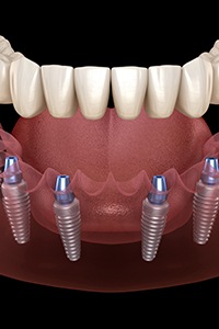 Illustration of implant dentures