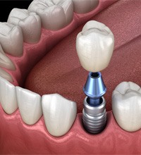 a digital illustration depicting an implant crown