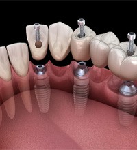 a digital illustration showing an implant bridge