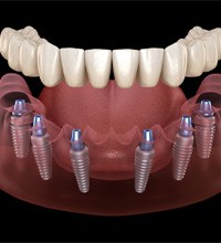 a digital illustration showing an implant denture