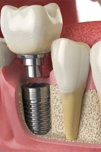 a digital illustration of an implant crown