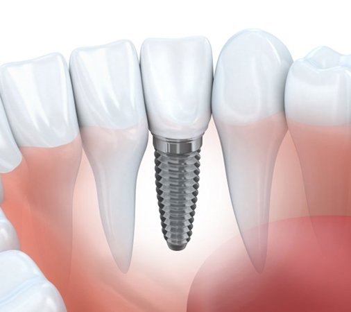 A diagram of a dental implant.