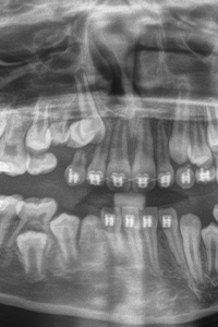 X-ray of impacted canine