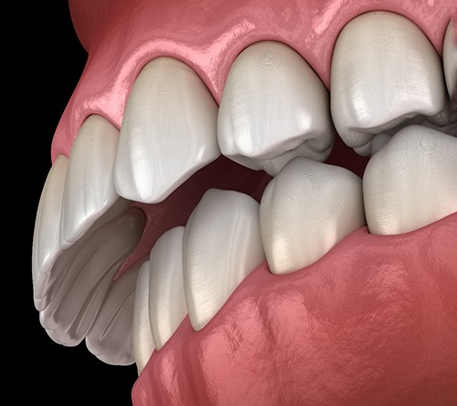 Illustration of a severe overbite before orthognathic surgery in Prosper, TX