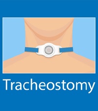 illustration of a tracheostomy