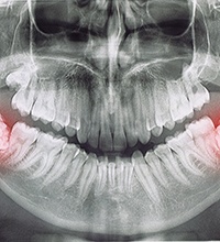 X-ray of impacted wisdom teeth