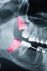 X-ray of impacted wisdom tooth