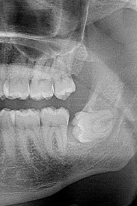 X-ray of impacted lower wisdom tooth