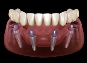 Digital image of All-On-4 dental implants