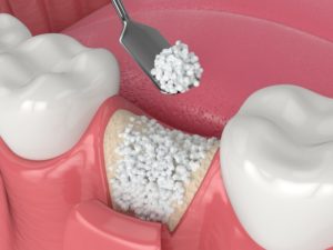  illustration of bone graft