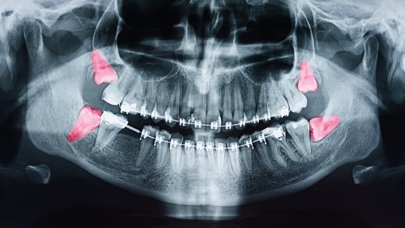 Impacted wisdom teeth shown in X-ray