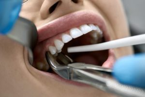 a woman getting her tooth removed