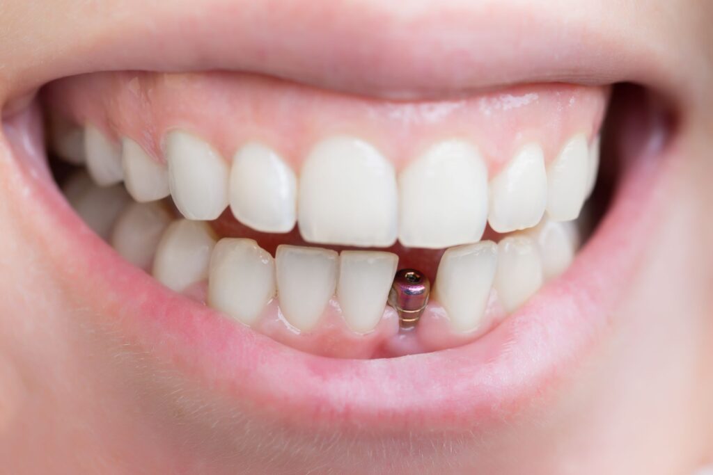 Closeup of a dental implant placed in patient's lower arch