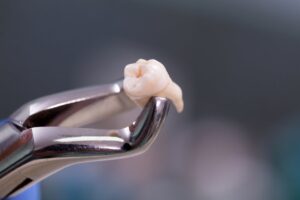 Forceps holding extracted tooth. 